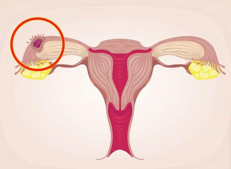 Dấu hiệu thai ngoài tử cung, nguyên nhân và cách phòng ngừa mẹ cần biết