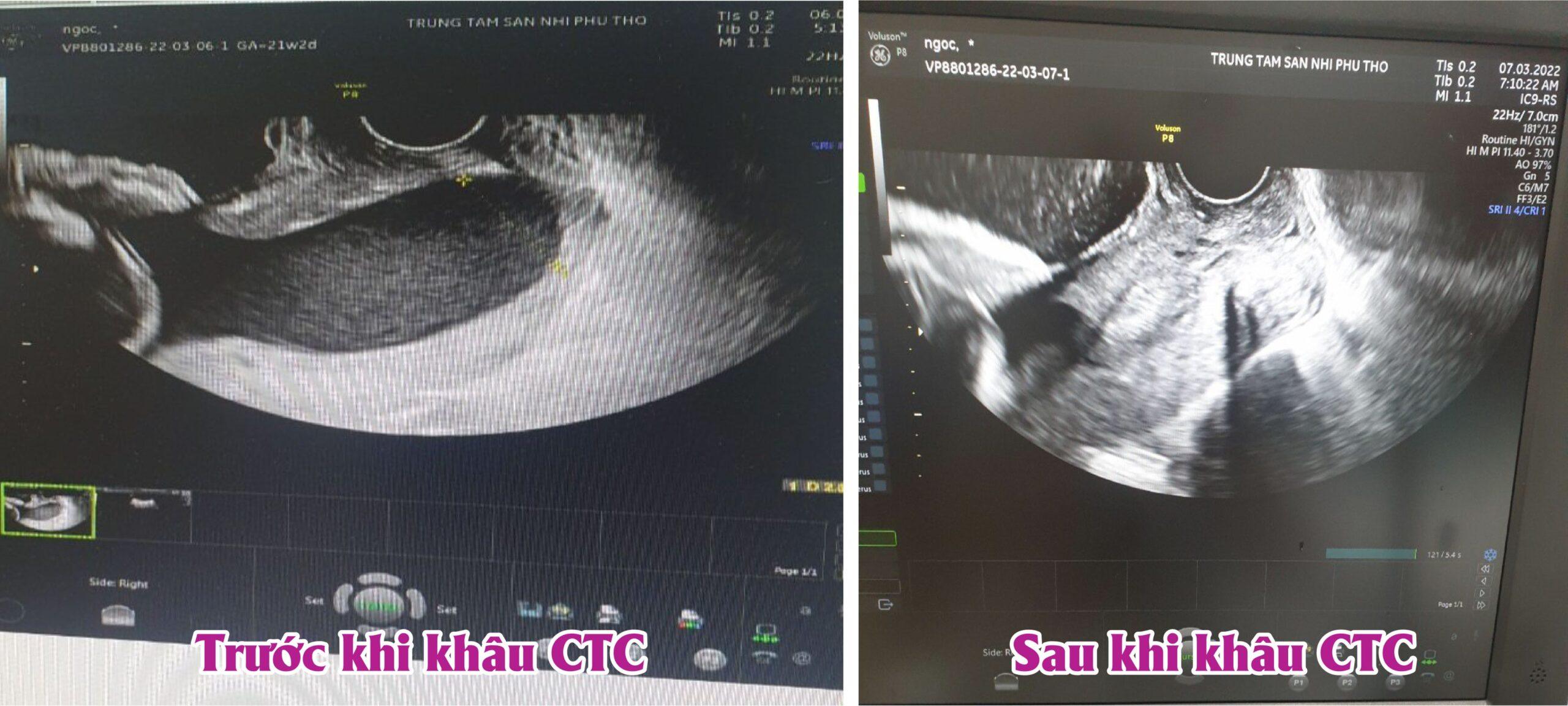 Hình ảnh siêu âm trước và sau khi khâu eo tử cung cho thai phụ N.